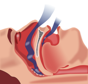Illustration of blocked airways during sleep
